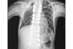 https://upload.wikimedia.org/wikipedia/commons/3/3b/Medical_X-Ray_imaging_AOX02_nevit.jpg