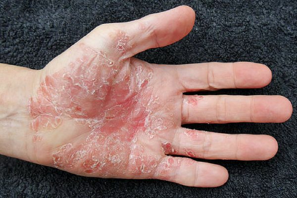 How A Pest Can Help With Psoriatic Arthritis The Massage Therapist